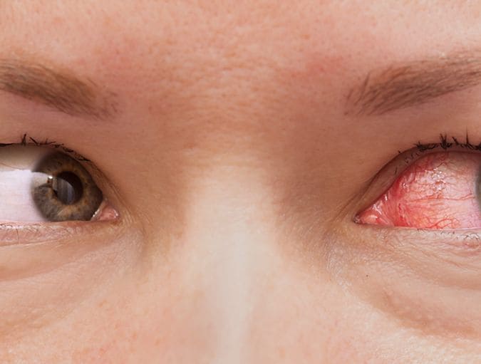 Contact_Lenses_and_Eye_Infections_row_1