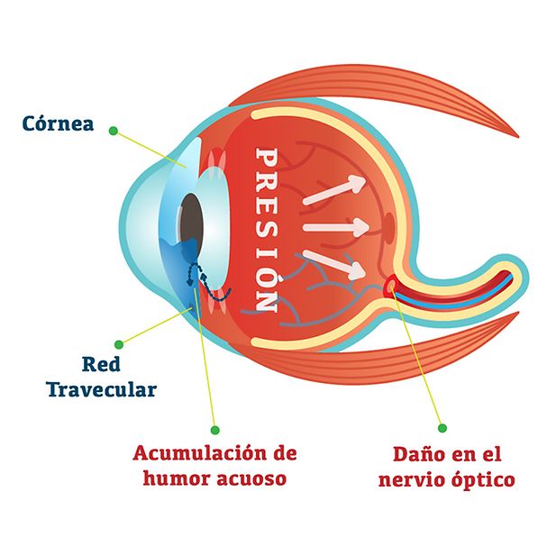 Ocular_Glaucoma_row_3