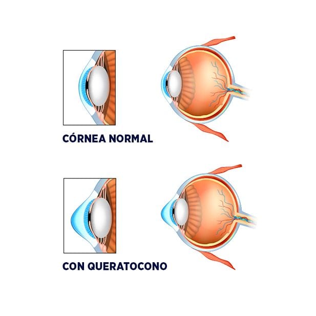 BLOG_stephen-curry-lentillas-queratocono_ES_Inline_1