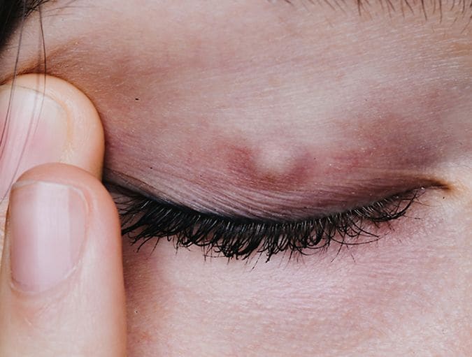 Contacts_and_chalazion_row_1