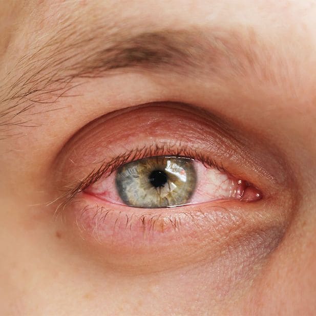 CMS_conjuntivitis-infeccion-del-ojo_ES_inline_1 (1)