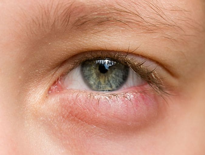CMS_salud-ocular_parpados-ojos-hinchados_ES_Banner