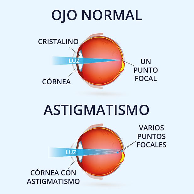 Diagrama de un globo ocular con y sin astigmatismo