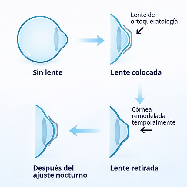 Diagrama de la forma del globo ocular antes, durante y después del uso de una lente Ortho-k